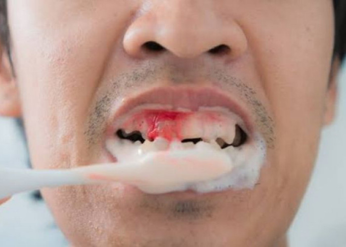 Bahaya Penularan HIV, Apakah Bisa Ditularkan Melalui Sikat Gigi?