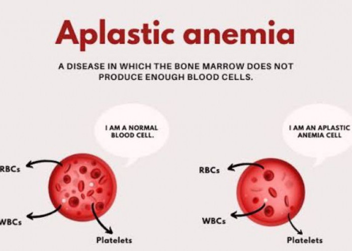 Viral di Sosial Media, Benarkah Obat Sakit Kepala Picu Anemia Aplastik?