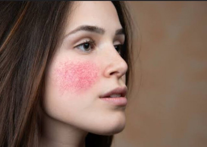 Kandungan Niacinamide Dalam Skincare Bisa Sebabkan Alergi, Simak Penjelasanya