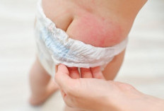 Cara Ampuh Atasi Ruam Popok pada Bayi