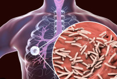 5 Faktor yang Membuat Bakteri TBC Mudah Berkembang di Tubuh