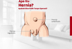 3 Pengobatan Alami untuk Penderita Hernia