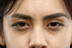 Cara Mencegah dan Menghilangkan Mata Panda agar Tidak Semakin Parah